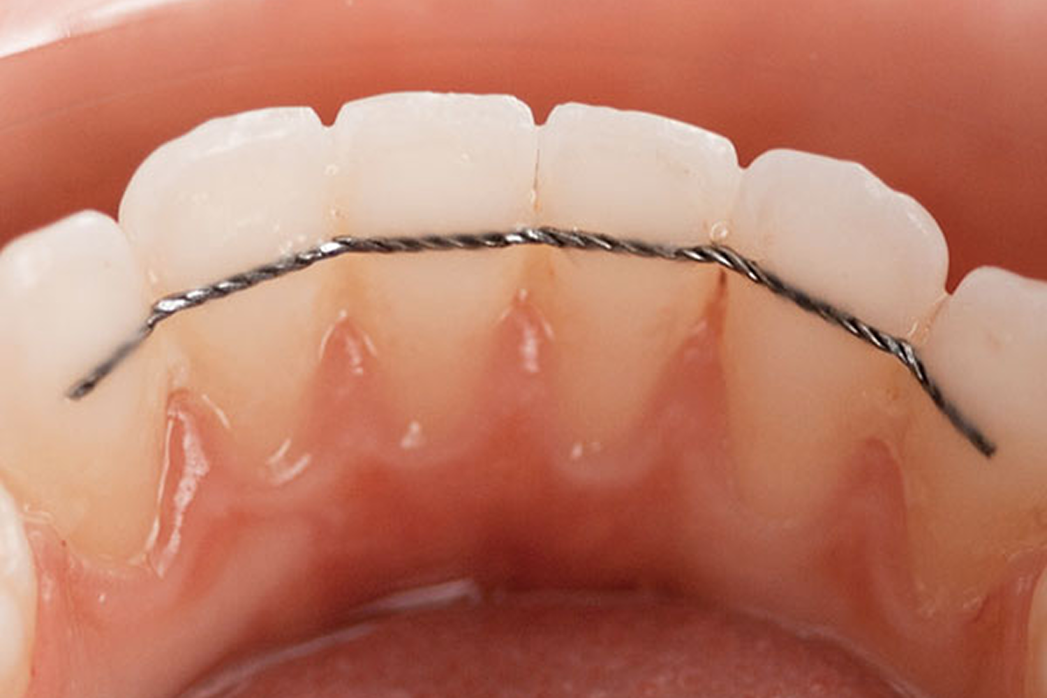 Fil de contention fixé sur la face interne des dents