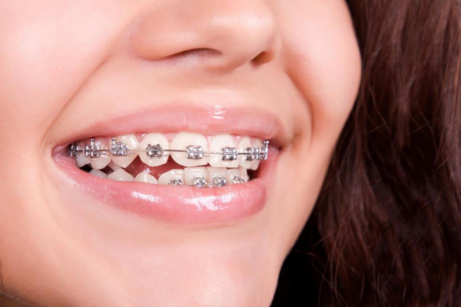 Détail d’un appareil orthodontique multi-attaches métallique