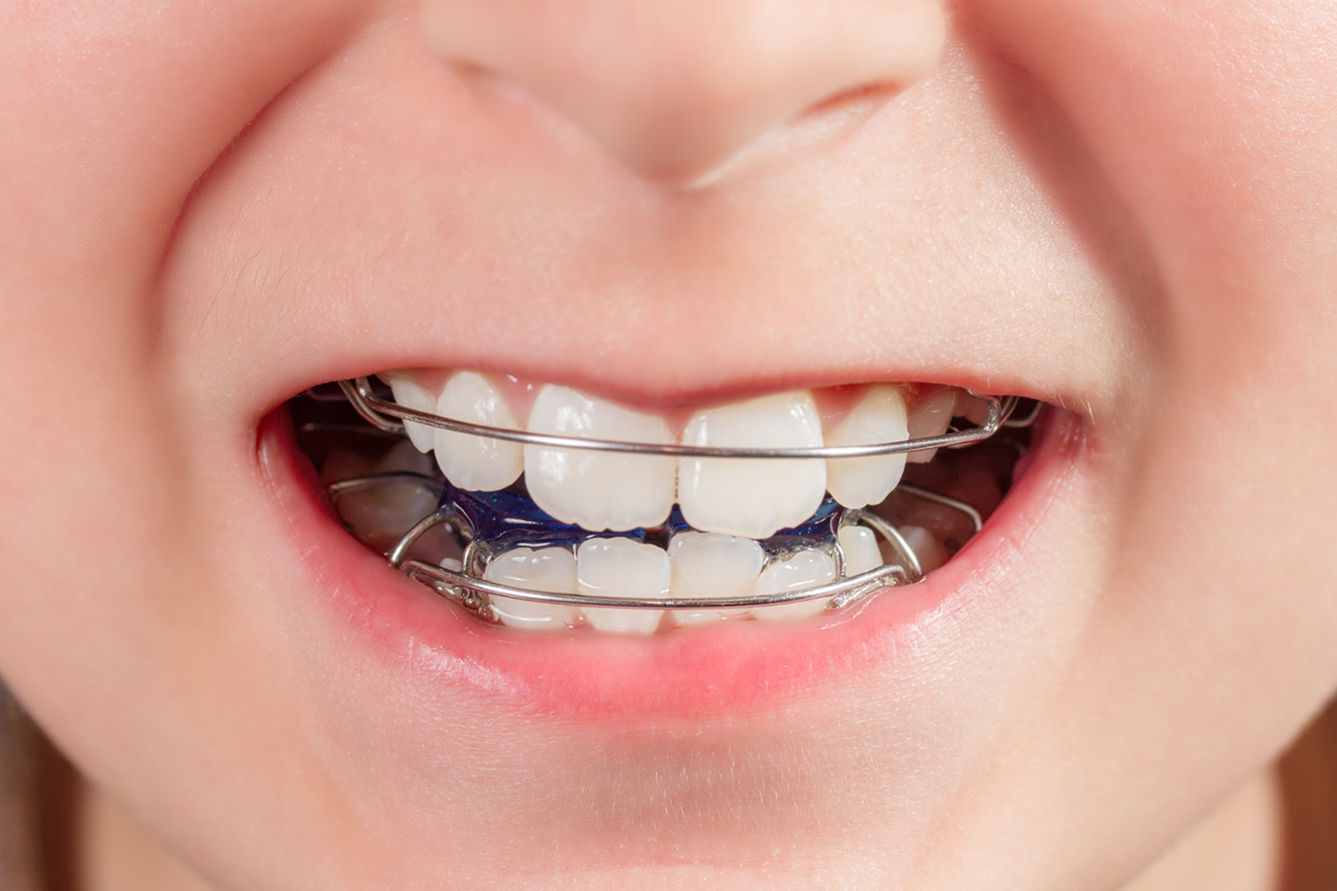 Appareil orthodontique porté par un enfant